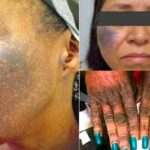 Bleaching: The Worst Skin Care to Abolished